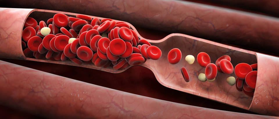 Image result for Vrste krvnih ugrušaka: arterijski i venski